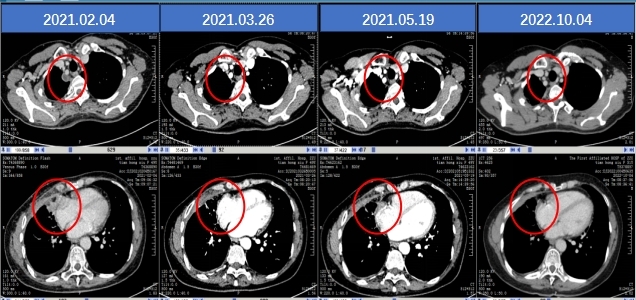 三代ALK抑制剂CT-3505治疗耐药患者病例分享