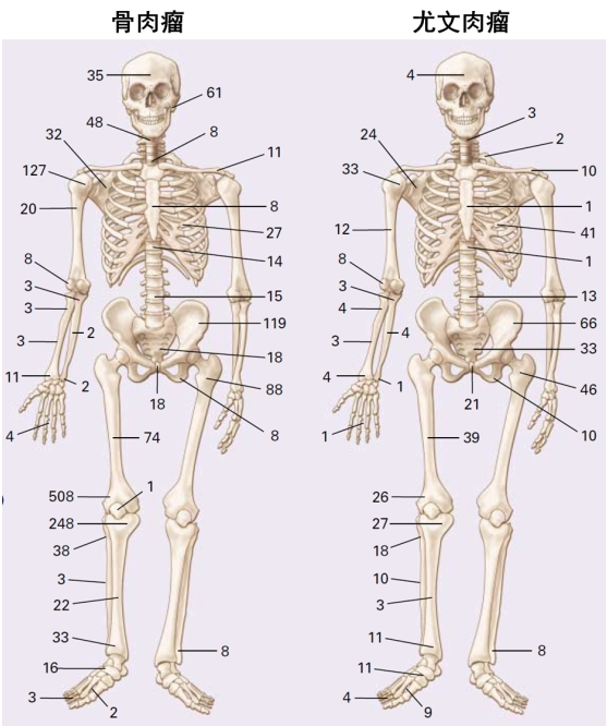 2.28国际罕见病日|警惕“生长痛”背后罕见的沉默杀手——骨肉瘤与尤文肉瘤骨肉瘤 2.28国际罕见病日|警惕“生长痛”背后罕见的沉默杀手——骨肉瘤与尤文肉瘤骨肉瘤
