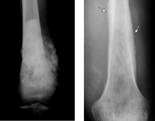 2.28国际罕见病日|警惕“生长痛”背后罕见的沉默杀手——骨肉瘤与尤文肉瘤骨肉瘤 2.28国际罕见病日|警惕“生长痛”背后罕见的沉默杀手——骨肉瘤与尤文肉瘤骨肉瘤
