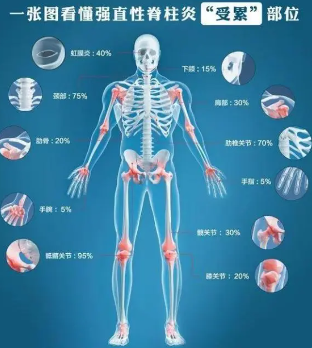 明星也逃不掉的强直性脊柱炎 究竟是个什么病？