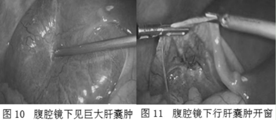 肝囊肿的微创治疗，你知道吗？