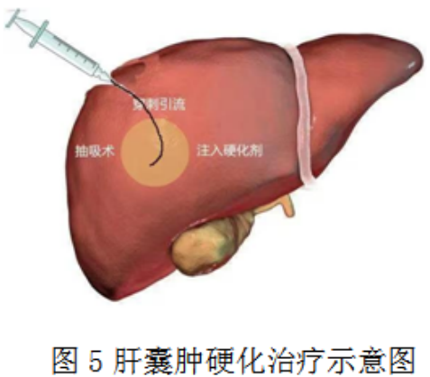 肝囊肿的微创治疗，你知道吗？