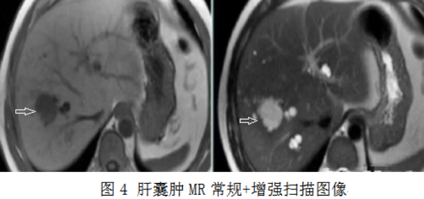 肝囊肿的微创治疗，你知道吗？