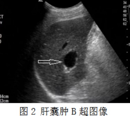 肝囊肿的微创治疗，你知道吗？