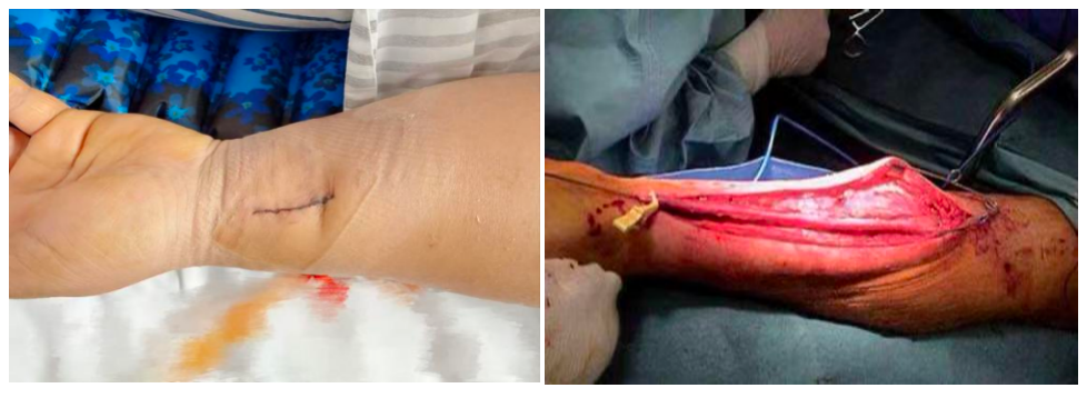 浙江首例！腔镜辅助“全动脉化”心脏搭桥成功实施