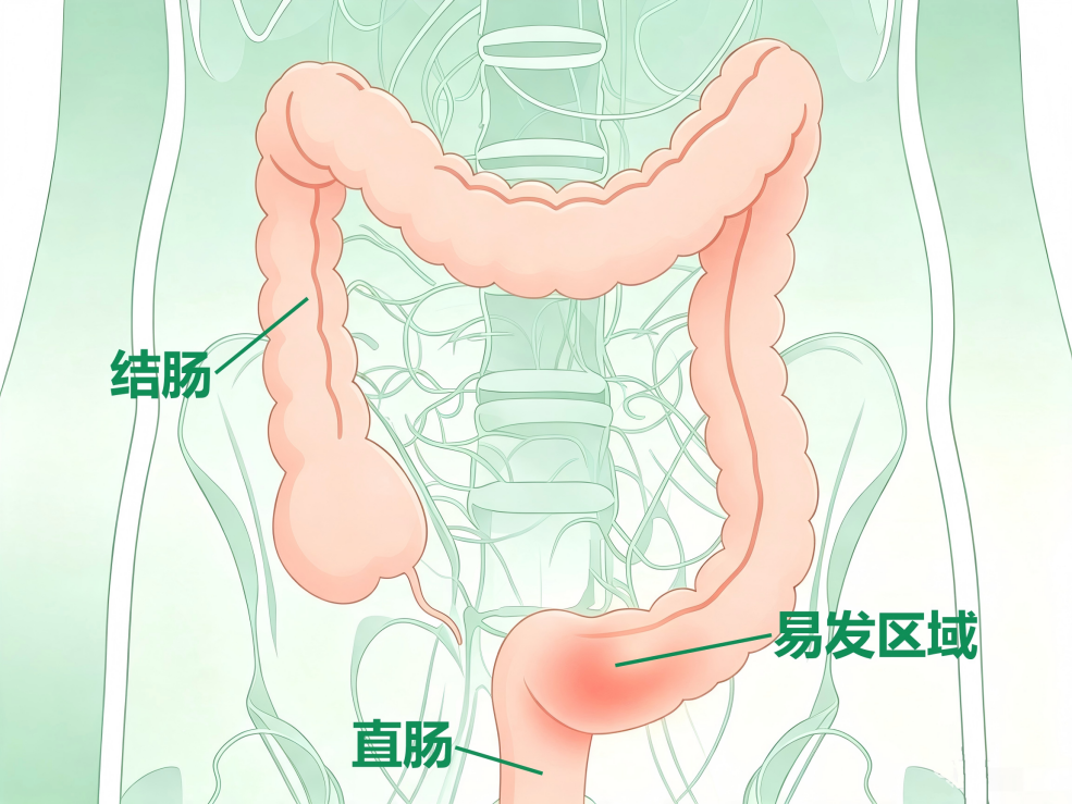 日本作家东野圭吾离世，哪些肠癌风险需正视？