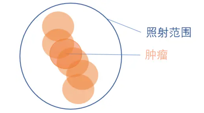 国际肺癌日 | 原来肺癌放疗也可以这么做