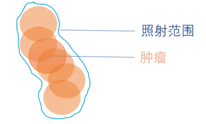 国际肺癌日 | 原来肺癌放疗也可以这么做